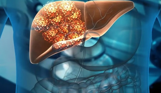 Thiếu nữ 16 tuổi ở Quảng Ninh suy gan cấp do mắc sai lầm này trong lúc giảm cân