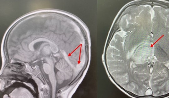 Bé 2,5 tuổi phát hiện bị đột quỵ từ dấu hiệu nhiều trẻ em Việt mắc phải