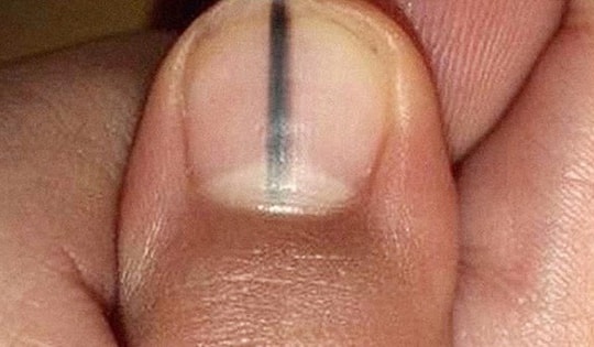 Nếu móng tay có dấu hiệu này, cẩn thận với ung thư hắc tố