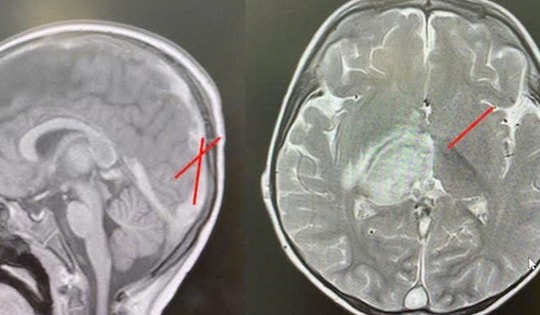 Cứu sống bé trai 2,5 tuổi bị huyết khối nội sọ do rối loạn chuyển hóa hiếm gặp