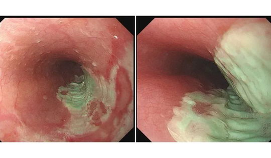 Người đàn ông 35 tuổi bị loét thực quản vì mắc sai lầm này khi uống thuốc