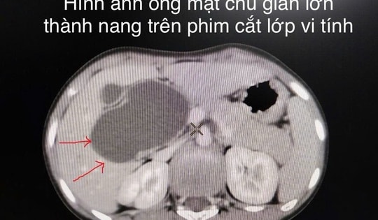 Bệnh viện Trẻ em Hải Phòng nội soi cắt nang ống mật chủ lớn cho bệnh nhi 10 tuổi