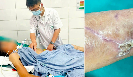 Người đàn ông 65 tuổi co giật, cứng hàm sau cú ngã đập tay vào thanh gỗ