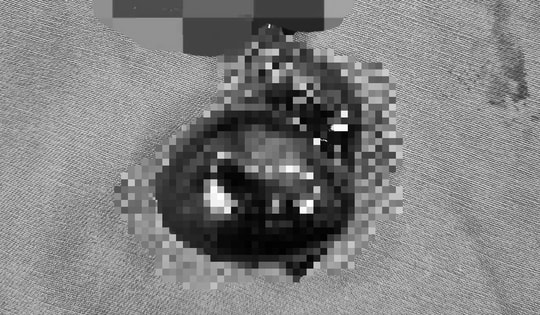 Nam sinh 15 tuổi phải cắt bỏ tinh hoàn vì đau nhưng ngại nói với cha mẹ