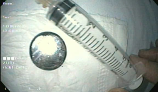 Cấp cứu thành công bé 18 tháng tuổi ở Hải Phòng nuốt pin cúc