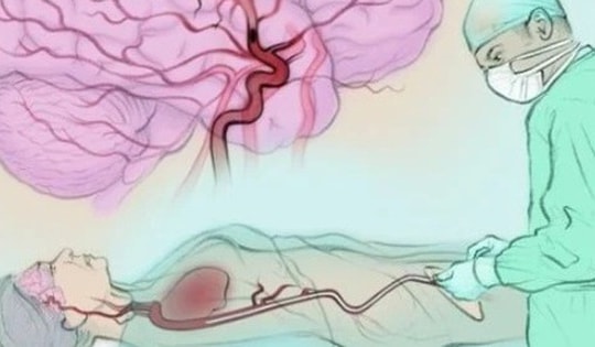 Người phụ nữ 57 tuổi đột quỵ liên tiếp 2 lần trong 2 ngày thừa nhận bỏ qua dấu hiệu báo bệnh này