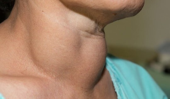 3 dấu hiệu quan trọng cảnh báo ung thư tuyến giáp, nếu xuất hiện 1 trong 3, cần đi khám ngay