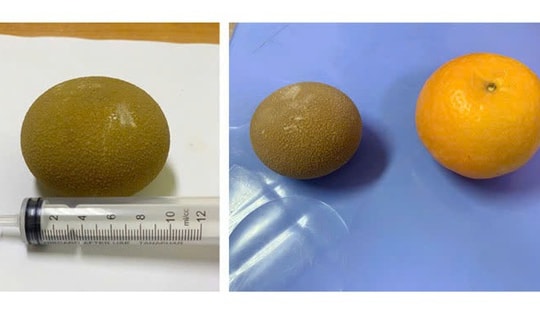 Phát hiện sỏi bàng quang to như quả cam trong người đàn ông 69 tuổi ở Quảng Ninh