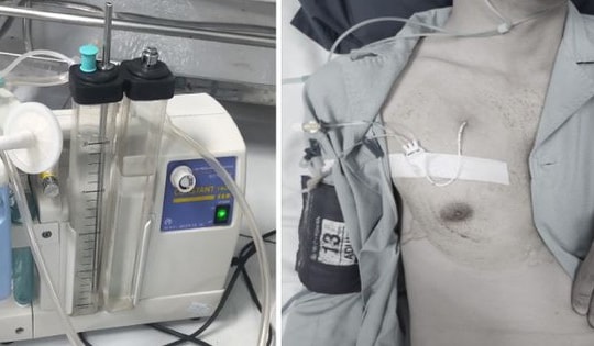 Thanh niên 25 tuổi ở Hà Nội nhập viện vì tràn khí màng phổi khi tập gym từng mắc bệnh này, ai có dấu hiệu cần cảnh giác!