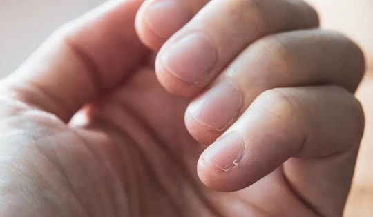 1 thay đổi nhỏ ở ngón tay có thể là dấu hiệu sớm của ung thư phổi: Người hút thuốc lá cần kiểm tra ngay