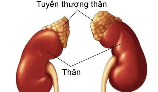 Suy tuyến thượng thận do lạm dụng thuốc điều trị bệnh gout