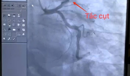 Người đàn ông 43 tuổi đột ngột nhồi máu cơ tim ngay trên đường đi làm thừa nhận có thói quen này