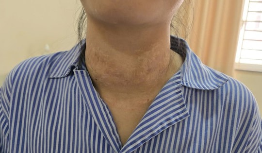 Sẹo chằng chịt ở cổ do đắp lá điều trị u tuyến giáp lành tính