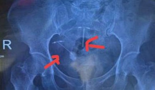 Vòng tránh thai xuyên vào bàng quang, tạo sỏi lớn
