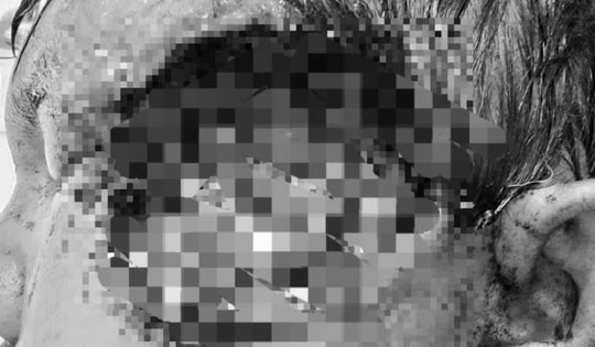 Dòi bò lúc nhúc trên mặt người đàn ông do đổ thuốc diệt cỏ vào má và những cách chữa bệnh tai hại không giống ai!