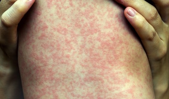 Bolivia ban bố tình trạng khẩn cấp y tế do dịch sởi bùng phát