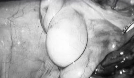 Bé trai 11 tuổi thoát nguy cơ vô sinh nhờ ca mổ nội soi hạ tinh hoàn