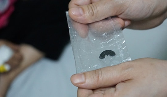 Cúc áo gãy đôi nằm trong đường thở bé gái 5 tuổi