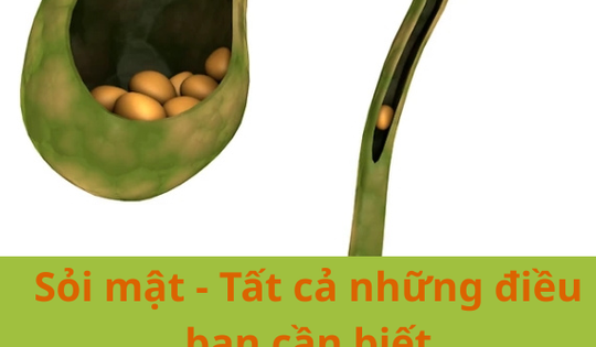 Sỏi mật - Tất cả những điều bạn cần biết