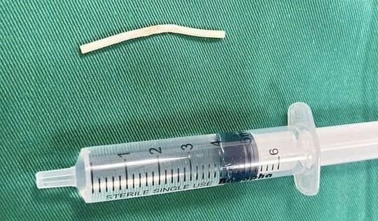 Cánh tay đau dai dẳng vì que cấy tránh thai 'đi lạc'