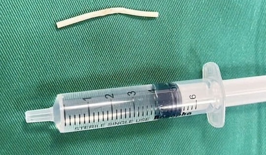 Người phụ nữ 35 tuổi ở Hải Dương phải phẫu thuật vì que tránh thai 'đi lạc' trong cánh tay
