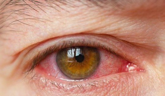 Thêm liệu pháp mới điều trị bệnh khô mắt