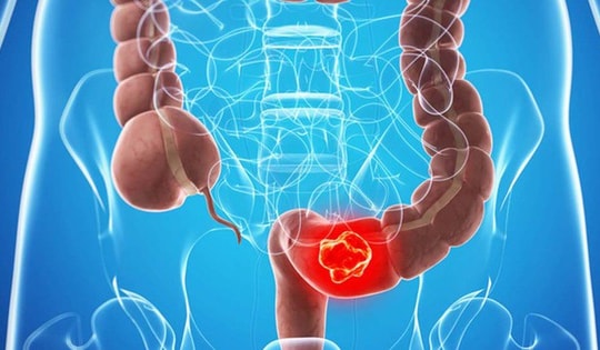 Người phụ nữ 64 tuổi bất ngờ phát hiện ung thư đại tràng di căn phổi từ dấu hiệu nhiều người Việt bỏ qua