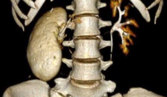 Cô gái 18 tuổi có thận 'hóa đá' và những sai lầm tàn phá thận một cách nhanh chóng của nhiều người