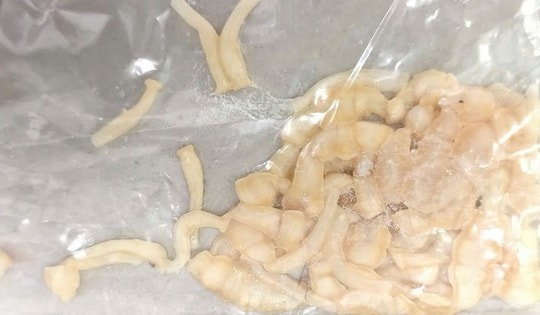 Nam thanh niên 30 tuổi ở Phú Thọ có sán dây dài hơn 3 mét do thường xuyên ăn món quen thuộc này