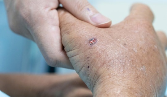 Chạm vào tổ ong vò vẽ, người đàn ông sốc phản vệ suýt mất mạng