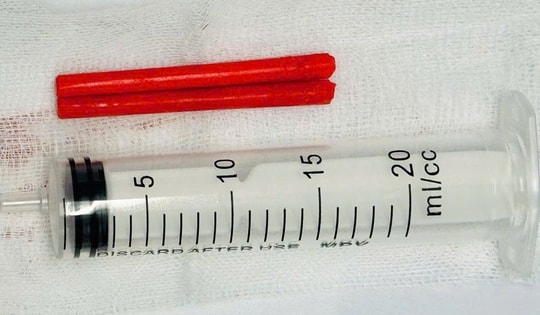 Hy hữu: ‘Bỏ quên’ hai đoạn đũa trong hốc mũi hơn một năm