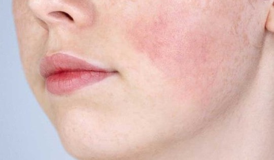 7 tác dụng phụ thường gặp khi sử dụng retinol và cách phòng ngừa