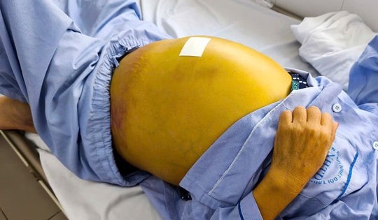 Người phụ nữ 61 tuổi suy gan nặng, nguy cơ tử vong cao do chủ quan với dấu hiệu này