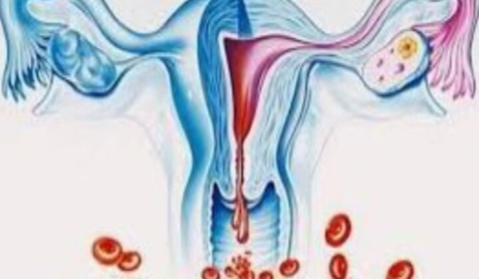 Bất ngờ 'thủ phạm' khiến người phụ nữ 40 tuổi bị rong kinh suốt 20 ngày