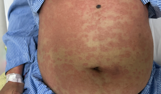 Một phụ nữ nguy kịch sau khi dùng thuốc giảm cân thải độc, collagen không rõ nguồn gốc