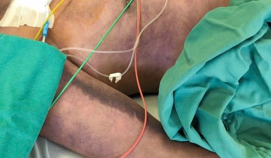 Người cao tuổi mắc liên cầu khuẩn lợn ở Hà Nội