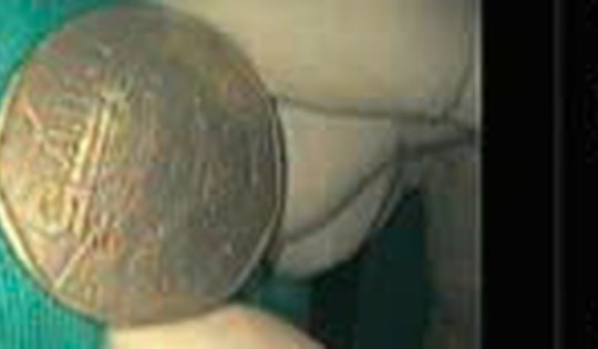 Bé trai 9 tuổi ngậm đồng xu trong việc rồi nuốt