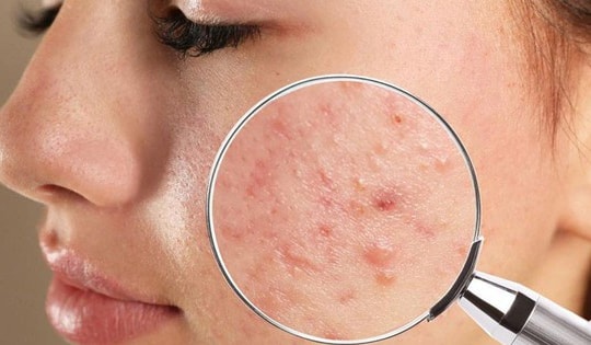 Bôi kem đánh răng có giúp điều trị mụn trứng cá?