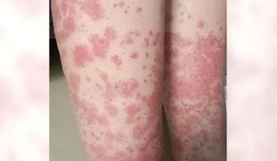 Nữ sinh trả giá đắt vì nhuộm tóc liên tục: Thận chảy máu, phải cạo đầu giữ mạng