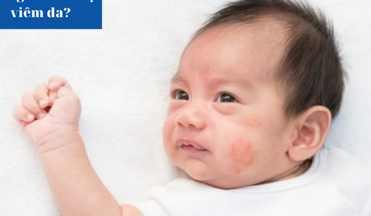 Làm gì khi trẻ bị viêm da?