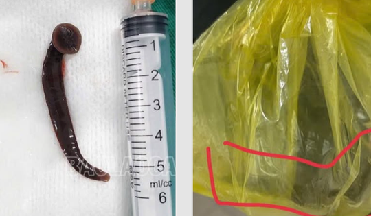 Bị đỉa chui vào niệu đạo khi đang làm đồng, người đàn ông có một hành động bất ngờ