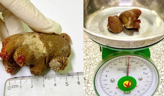 Người đàn ông 46 tuổi ở Quảng Ninh có sỏi thận 'khủng' như san hô do mắc sai lầm này trong nhiều năm