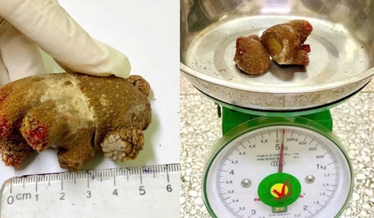 Viên sỏi thận 'khổng lồ' như san hô nằm trong cơ thể người đàn ông gần 20 năm