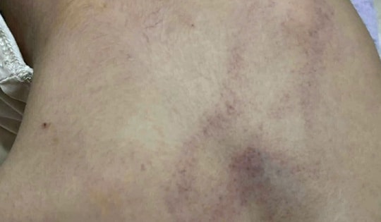 Bé gái mầm non nghi bị bạo hành, đánh tím lưng tại Hà Nội