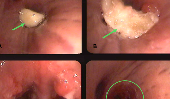 Người đàn ông nhập viện sau 14 ngày ăn bún vì một sai lầm nhiều người Việt mắc phải