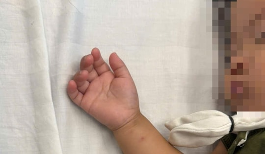 Bé gái hơn 2 tuổi nhập viện gấp do tai nạn tại nhà hay gặp ở trẻ nhỏ