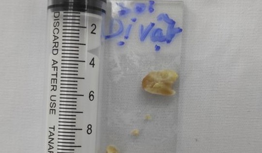 Hạt lạc mắc trong phế quản, cụ ông ho dai dẳng