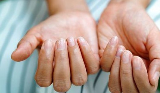 Bổ sung vitamin và khoáng chất nào khi móng tay giòn, dễ gãy?