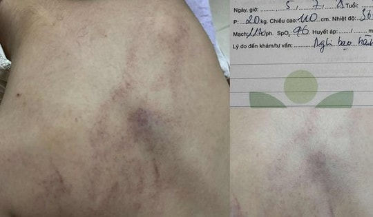 Cục Bà mẹ và Trẻ em lên tiếng về vụ trẻ bị bạo hành ở Trường mầm non Gia Thụy