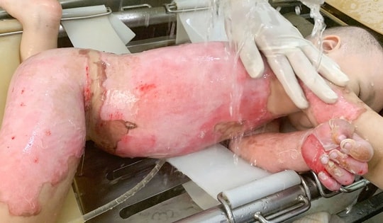 Bé 2 tuổi bỏng 60% được cứu sống nhờ ghép da từ mẹ